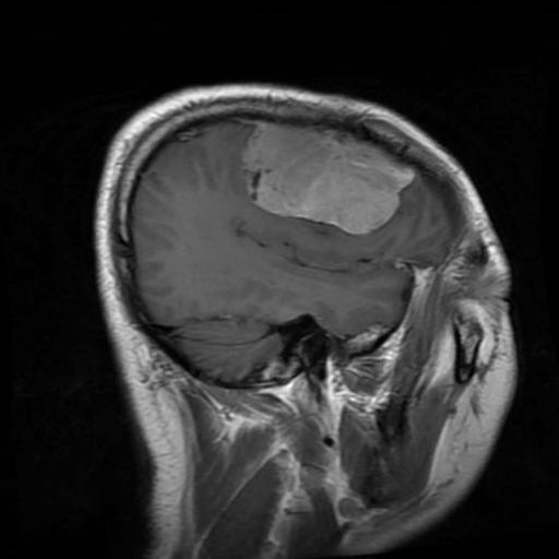 脑瘤MRI