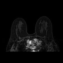 乳腺癌MRI