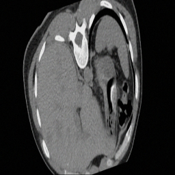 肝肿瘤MRI